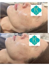 エステサロンケードット(Esthetic Salon K.)/小顔フェイシャルコース