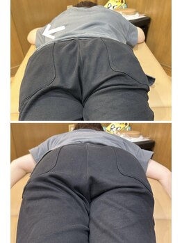 リノ25(LINO25)/骨盤矯正はとても大事!