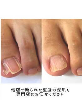 ティアラネイル 宇都宮/深爪矯正