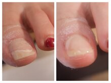 アヤネイル(Aya nail)/足の爪の補強