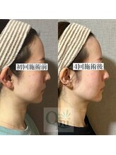 キュープ 浜松店(Qpu)/目指せ横顔美人！