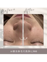 アムールドゥ 麻布十番(Amour deux)/毛穴洗浄