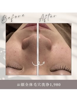 アムールドゥ 麻布十番(Amour deux)/毛穴洗浄