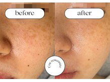 ユヌランコント 岐阜店(Une rencontre)/ジュエリーピーリング