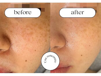 ユヌランコント 岐阜店(Une rencontre)/ジュエリーピーリング