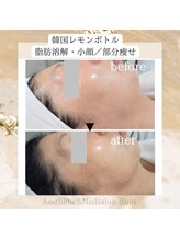 ビヌ(Binu)/韓国レモンボトル・小顔ケア