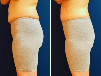 久留米スポーツ整骨院 整体院/エステ◆痩身インディバエステ