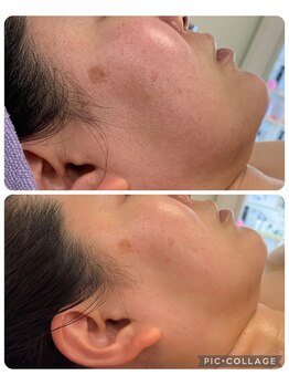 ルピナージュ(Lupinage)/【肌質改善】‐たるみ/しみケア-