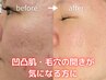 【幹細胞＋パック付き】凹凸肌改善　プロセルセラピーズ