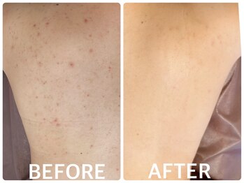 ハーブピーリング 心斎橋/背中ニキビ改善