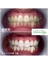 ホワイトニングサロン 名古屋駅店/【ホワイトニング施術例】