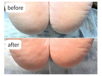 カシェット(Cachette)/50代男性◎足裏角質 かかと40分