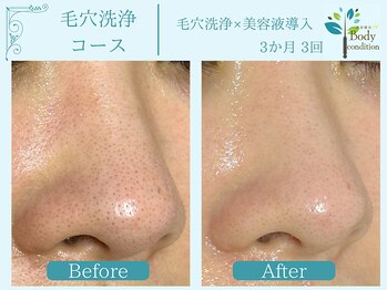 ボディコンディション/ハーブピーリング/毛穴洗浄/小顔