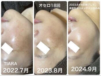 ティアラ(TIARA)/シミケア