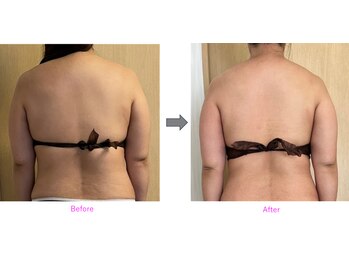 ルルラ(Rulula)/痩身ダイエット施術前後1