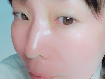 ミミエステティックス(Mimi Esthetics)の写真/＜シミケアお顔全体集中ケア＞お得なクーポンや短期間シミケア仕上げメニューをご用意★無料カウンセも◎