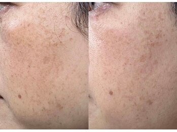 ユウビ ビューティー サロン(Yuubi)/【peel stage】ハーブピーリング