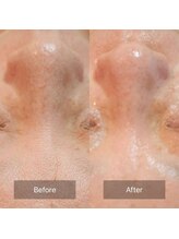 ローハ(ROHA)/毛穴洗浄×エイジングケア