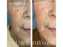 モエ ビューティーサロン(moe Beauty Salon)/１ヶ月肌質改善プログラム