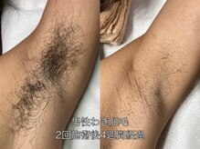 エクレ 柏店(EKURE)/メンズワキ脱毛