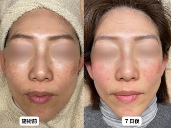 エングラッシー(en glassy)/BEFORE　AFTER　最新シミ回収