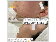 キャス(KYAS)の雰囲気（最短3ヶ月[茅ヶ崎/ハーブピーリング/しみニキビケア/毛穴/]）