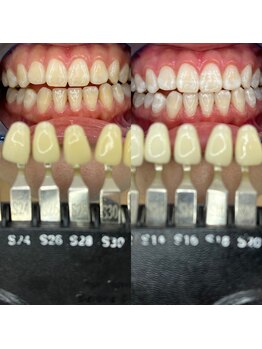 トウキョースワーズ 渋谷店(TOKYO SWRS)/#ホワイトニング #渋谷 #池袋