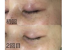 サロンドジェシカ(salon de Jessica)/プラズマ  目元のケア