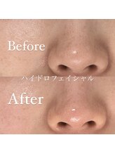 クリニカルホワイトケア 和泉府中店(クリニカルWHITEケア)/ハイドロフェイシャル