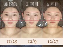 千歳の女神 久屋大通店/【施術風景】Berore/After