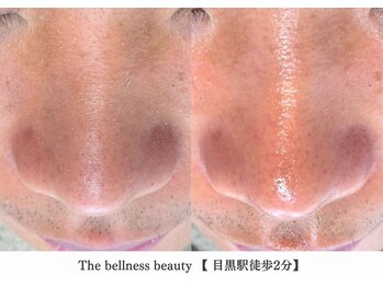 ザ ベルネス(The bellness)/【毛穴洗浄】東京/目黒駅