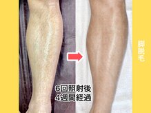 エクレ 柏店(EKURE)/メンズ脚脱毛