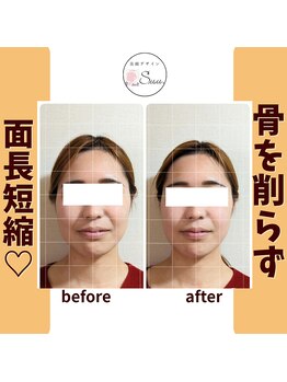 美顔デザインsuu.~若見えと歪み矯正専門の小顔サロン~/Before-After【30代】1回