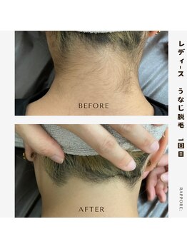 ラポール(rappore;)/うなじ脱毛