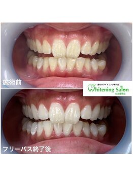 ホワイトニングサロン 名古屋駅店/【ホワイトニング施術例】