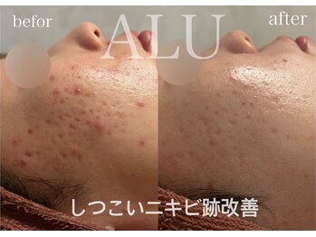 アルフォービューティー 恵比寿店(ALU for beauty)/ニキビ症例