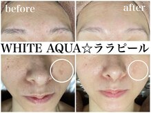 ホワイトアクア 梅田本店(WHITE AQUA)/ララピールでシミケア・しわ改善