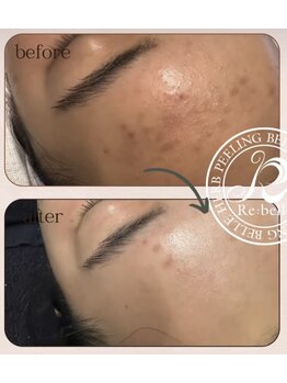 エヌ スタイル(N Style)/リベルハーブピーリング 