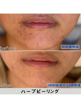 ルアナ 北谷店/ハーブピーリング 《沖縄/北谷》