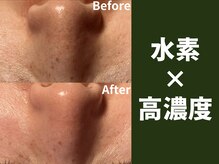 ポンディシェリ(Pondicherry)の雰囲気（全ての肌悩みに。まずの第一歩目としておすすめの施術）