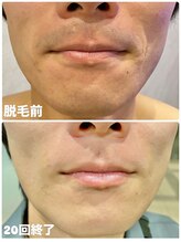 ワイズサロン(Y's salon)/セルフ脱毛でのヒゲ脱毛
