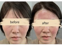 リズ(rE:S)/インモードリフティング/40代