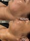 トータルビューティー ミミ(Total Beauty mimi)の写真/夏の紫外線ダメージ、秋のたるみにつながる前に...!!!