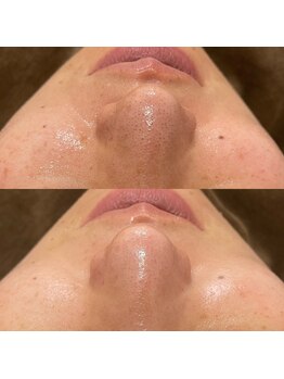 ラ クレール ビューティーサロン(LA CLAIR)/ハイドラ+AHAピーリング