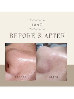 サンハート(SUN HEART)/毛穴集中コース