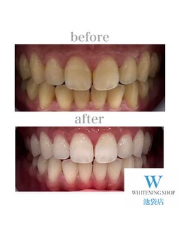 ホワイトニングショップ 池袋店/【ビフォーアフター】美白