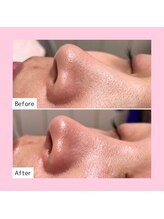 ホワイトラボ 岸和田店(White labo)/【施術例】ハイドロ毛穴洗浄