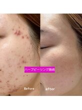 ティンクルホワイト 上尾店/ハーブピーリング施術後