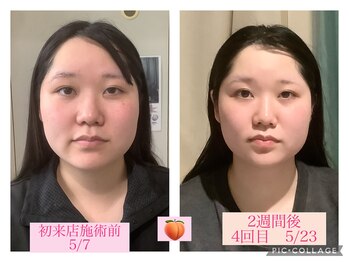 エクラ(Eclat)/小顔+肌質改善+たるみケア専門