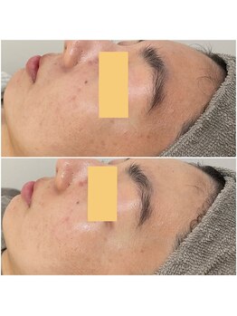 シースキン 盛岡駅前店(c.skin)/お客様ビフォーアフター♪